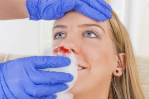 A woman is shown with a nosebleed.