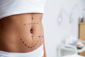 A woman's stomach is shown with markings for a weight-loss surgery.
