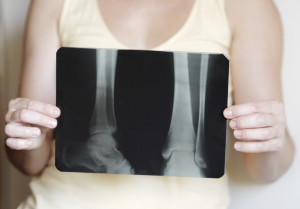 A woman holds an X-ray image of bones.