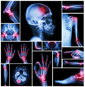 An illustration of bone pain is shown.