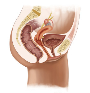 An illustration of a woman's pelvic area is shown.