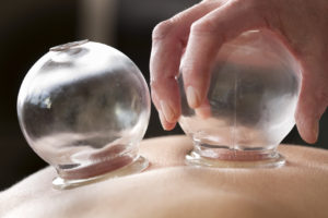A professional is conducting cupping therapy on a patient.