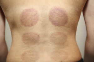 A person's back is shown with bruises left by cupping therapy. The bruises are circular in shape.