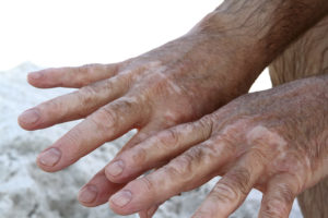 A man's hands are shown with vitiligo.