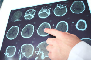 A medical professional points at an image of a brain.