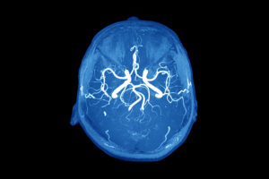 A brain is shown from superior view. The brain appears to be having an aneurysm.