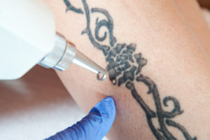 A person's arm tattoo is being removed by a professional.