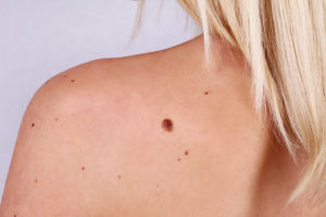 A woman's back with a few mole spots.
