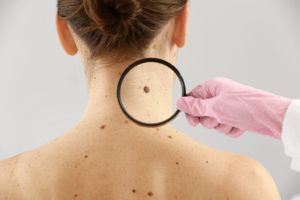 A medical professional examines a woman's neck with moles.