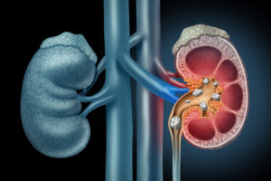 An illustration demonstrates what a kidney stone looks like.